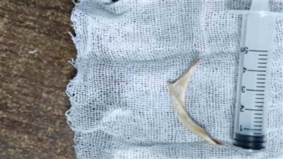 فريق طبي بـ«أسوان الجامعي» ينجح في استخراج جسم غريب من مرىء مريض