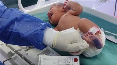 الصحة: فحص 45 ألف طفل حديثي الولادة للكشف المبكر عن الأمراض الوراثية