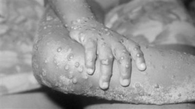 ألمانيا تعلن اكتشاف إصابتين بجدرى القردة فى برلين