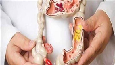 لأول مرة في التاريخ.. العالم قريب من إنتاج دواء للسرطان المستقيم 