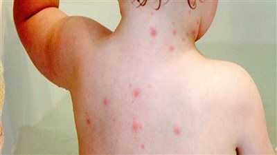 نيويورك تعلن حالة الطوارئ لمواجهة تفشي مرض «جدري القردة» 