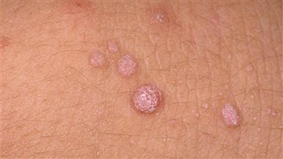 مرض جلدي غامض يظهر في الجزائر.. اعرف التفاصيل