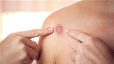 إصابات جدري القردة في أمريكا تتجاوز 26 ألف حالة مؤكدة