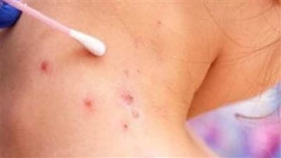 وزارة الصحة تعلن إيجابية حالة إصابة بفيروس جدري القرود