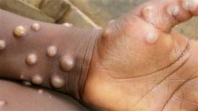 الصحة: جدري القردة غير مقلق من ناحية معدلات الانتشار وشدة المرض