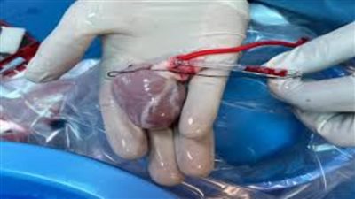 السعودية.. تفاصيل زراعة قلب لـ أصغر طفلة في الشرق الأوسط