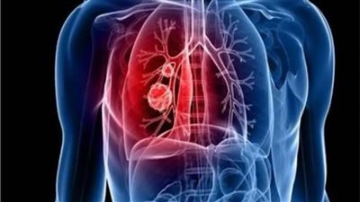 علامة على يدك اليمنى تشير على أصابتك بـ«سرطان الرئة» 