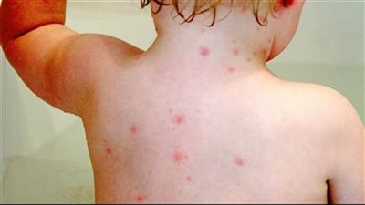 أعراض الجدري، احذري منتشر بين الأطفال في وقتنا الحالي 