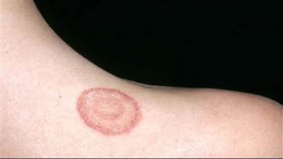 كل ما تريد معرفته عن القوباء مرض جلدي يصيب الأطفال 