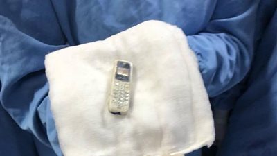 بعد 6 سنوات.. استخراج هاتف محمول من معدة مريض بمستشفى الباطنة بجامعة المنصورة