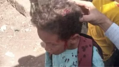 حدفوه بحجر من الخارج.. إصابة تلميذ في الرأس داخل مدرسة ابتدائية بقنا